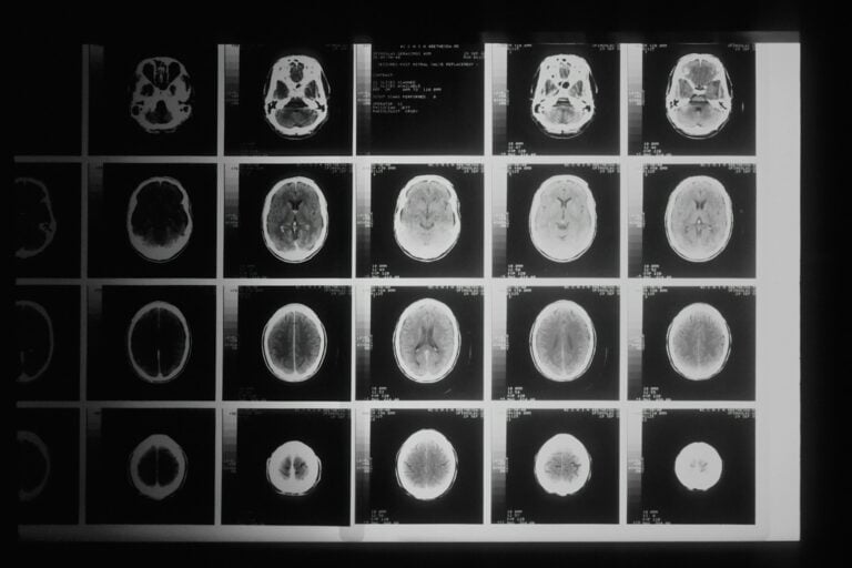 A sheet of brain scan images on a light box