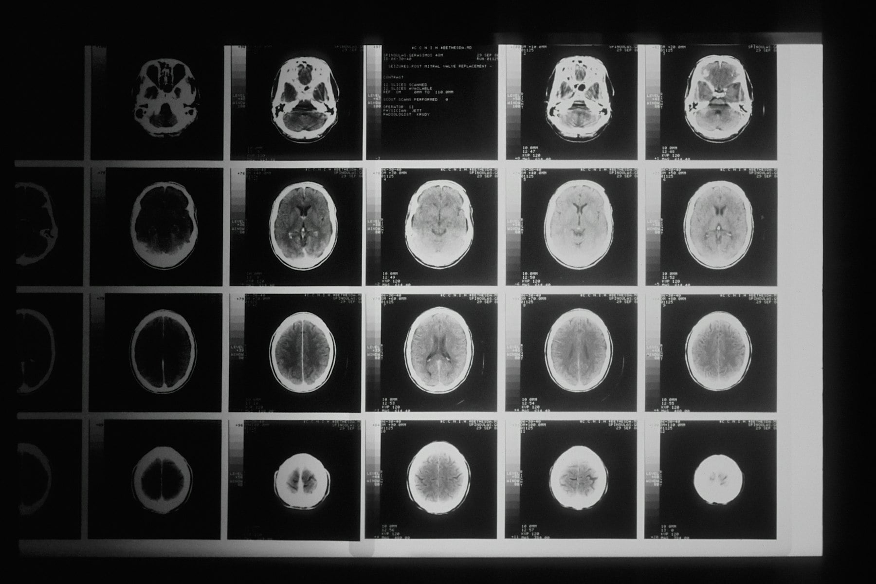 A sheet of brain scan images on a light box